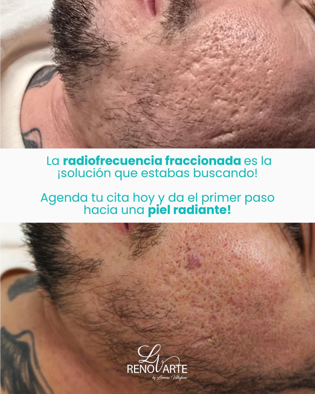 Radiofrecuencia Fraccional